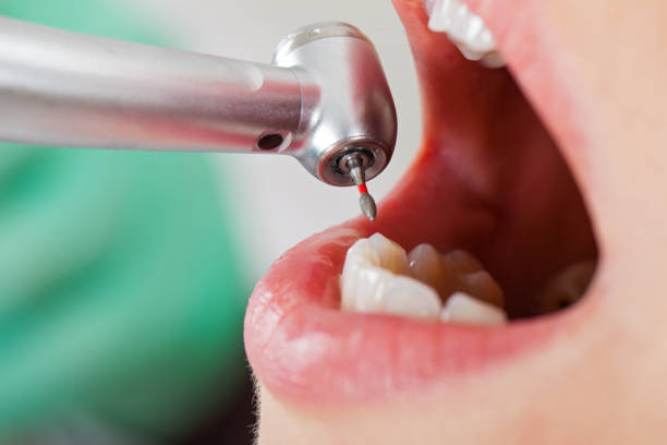 Best Emergency Dental Care for Broken or Chipped Teeth in Tolar, TX